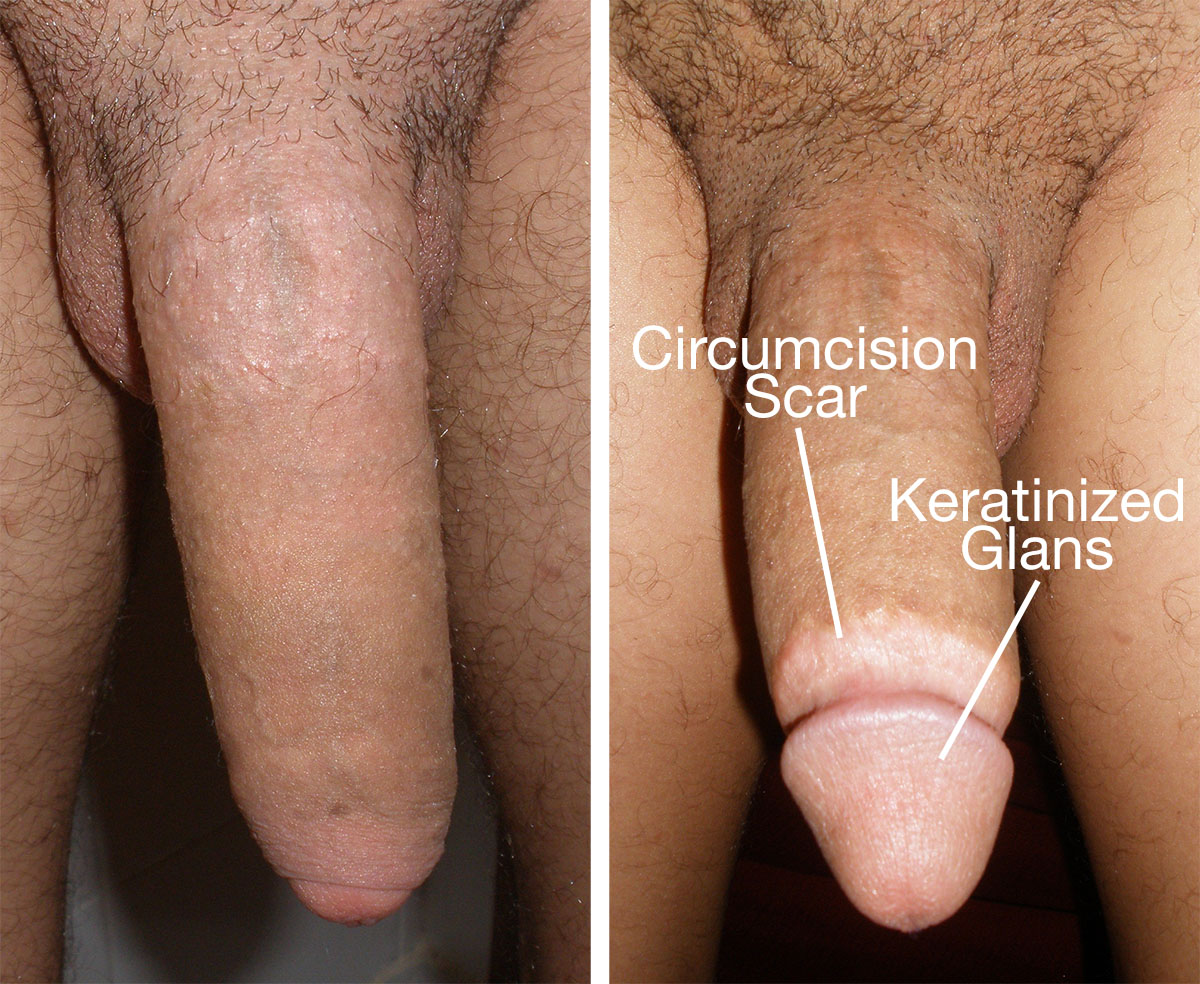 The Circumcision Debate A Health Vs Harm Analysis Of,Naked Circumcised Peni...